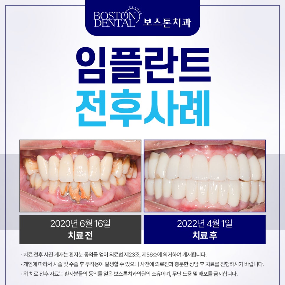 명동치과 잇몸이 안좋고 이가 계속 빠져서 밥먹기가 힘들어요. 관련 이미지 1