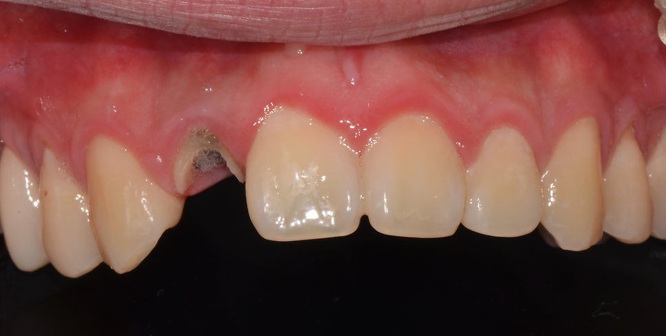 을지로치과 예전에 신경치료한 치아가 음식먹다가 부러졌어요. 관련 이미지 2