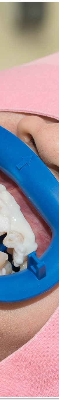 광화문역치과 생활습관에 따른 맞춤형 미백 관리 관련 이미지 21