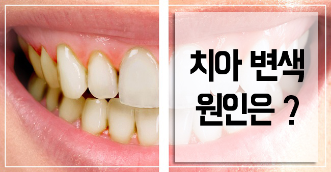 치아 변색 원인 1위, 홍차 관련 이미지 1