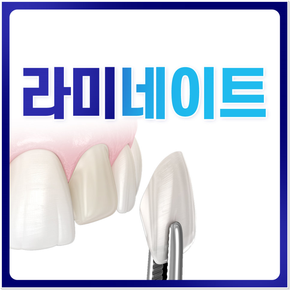 광화문역치과 치아미백과 라미네이트 나에게 필요한 건? 관련 이미지 1