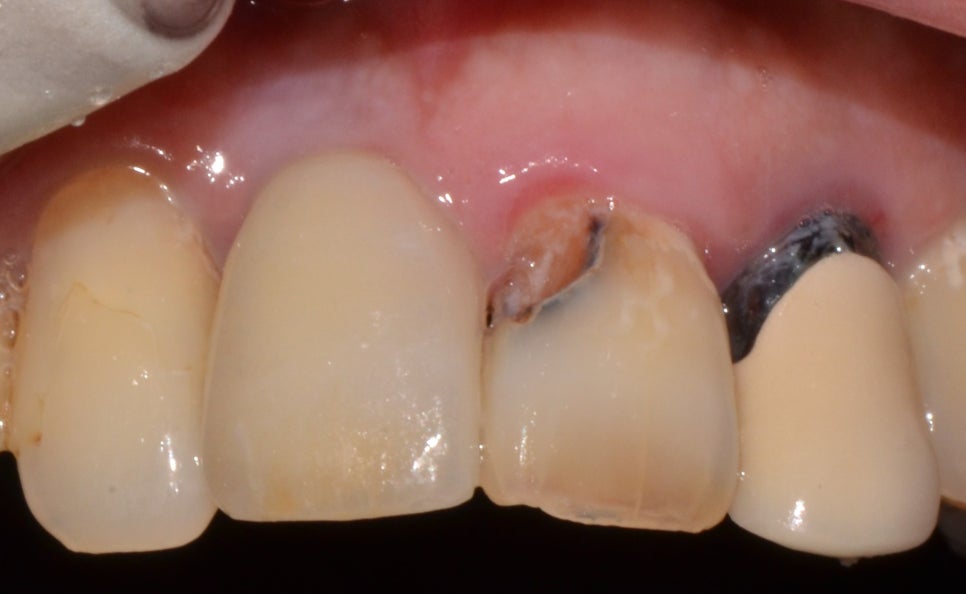 을지로입구역치과 앞니가 흔들리고 아파요 관련 이미지 4