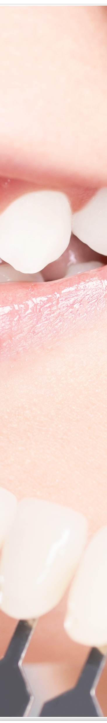 종로치과에서 알려드리는 치아미백과 라미네이트의 모든 것 관련 이미지 37