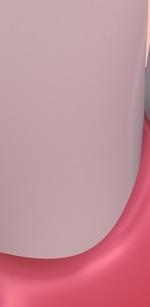 명동역치과 라미네이트 삭제된 치아는 다시 자라지 않습니다. 관련 이미지 22