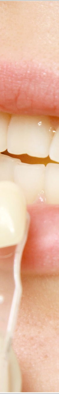 명동라미네이트, 단시간에 환한 미소를 가지고 싶다면? 관련 이미지 9