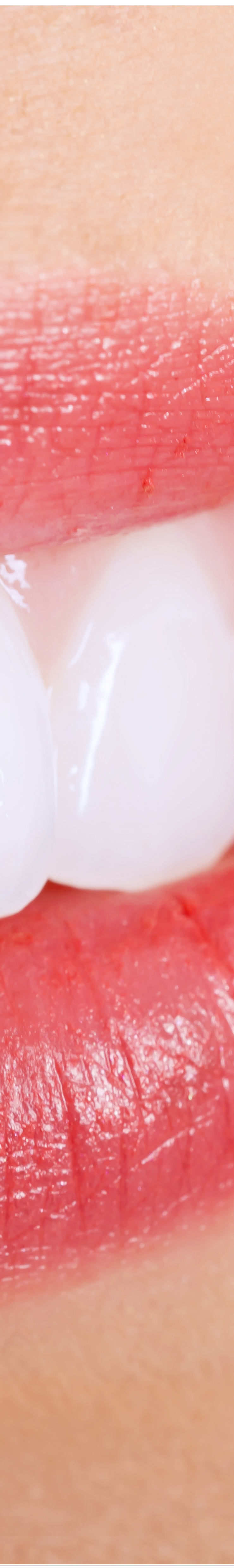 종로3가치과에서 알려드리는 무삭제 라미네이트 완벽 가이드 관련 이미지 16