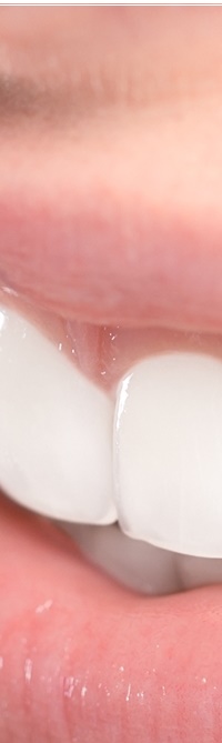 종로치과 라미네이트 주변 치아를 확인하여 자연스럽게 관련 이미지 12