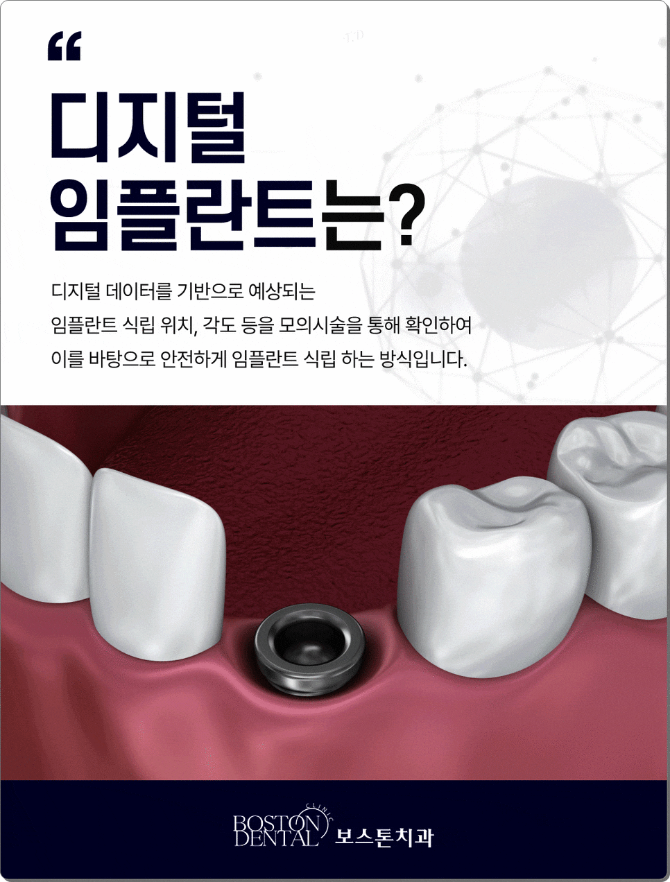 명동치과 임플란트 한 후에 먹는 음식들 관련 이미지 4