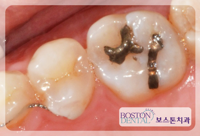 광화문치과추천 충치치료 편하게~ 관련 이미지 5