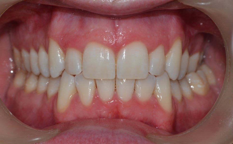 을지로입구역치과 치아 미백 전후 알아봐요! (Tooth whitening) 관련 이미지 2