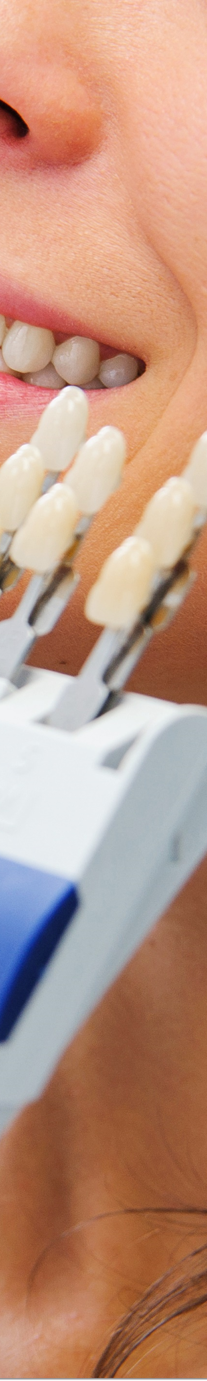 광화문역치과 라미네이트 치료가 궁금해요 관련 이미지 36