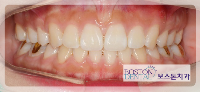 광화문치아교정 누구나 OK 관련 이미지 5