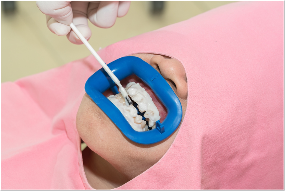 종로치과 치아미백 효과는 얼마나 지속될까? 관련 이미지 6