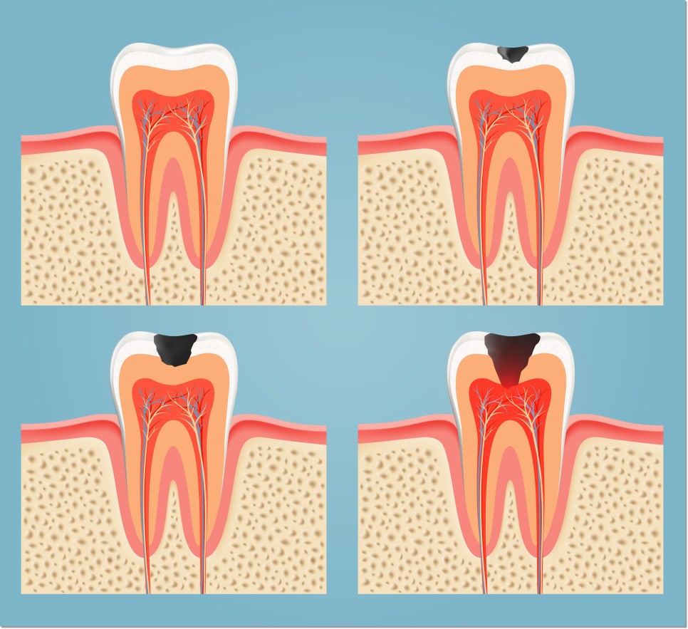 충치는 왜 생기는 것일까요? 관련 이미지 1