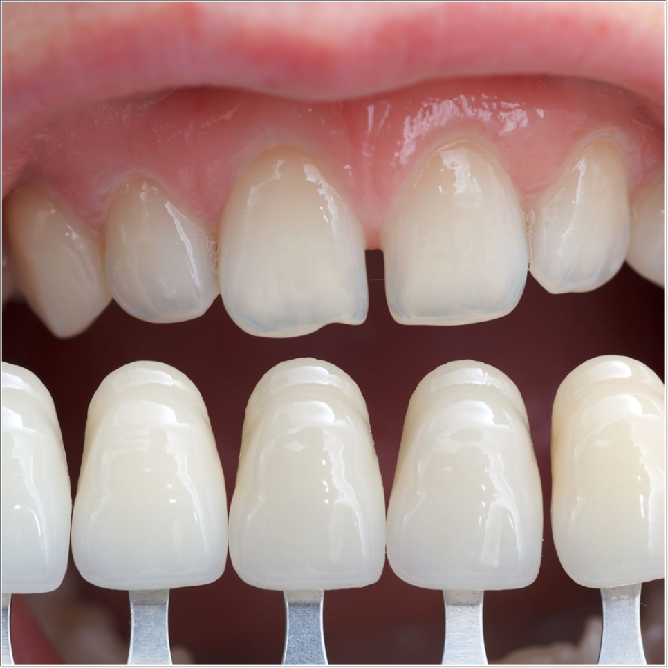 치아 변색 고민 끝, 을지로치과에서 듣는 라미네이트 사례 관련 이미지 14