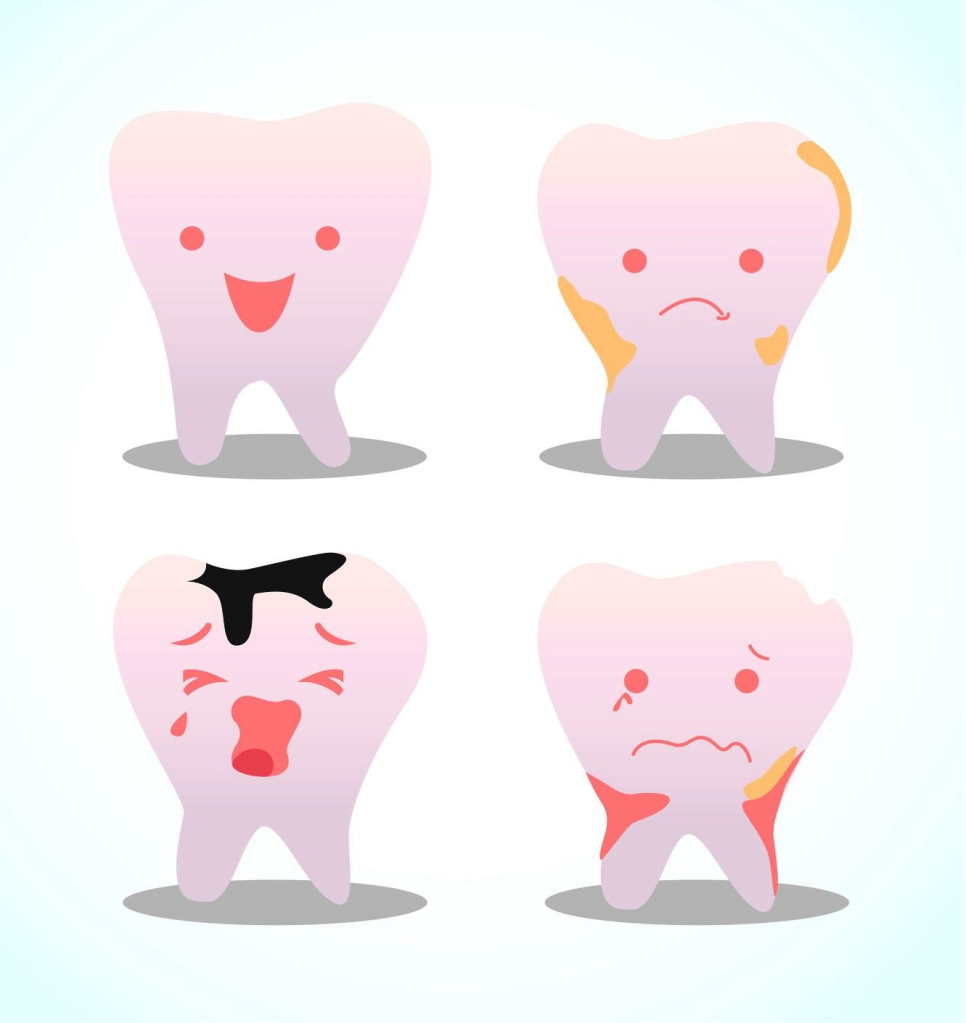 충치, 치료 미루면 더 아프고 더 비싸집니다 &ndash; 종각치과에서 꼭 알아야 할 이야기 관련 이미지 10