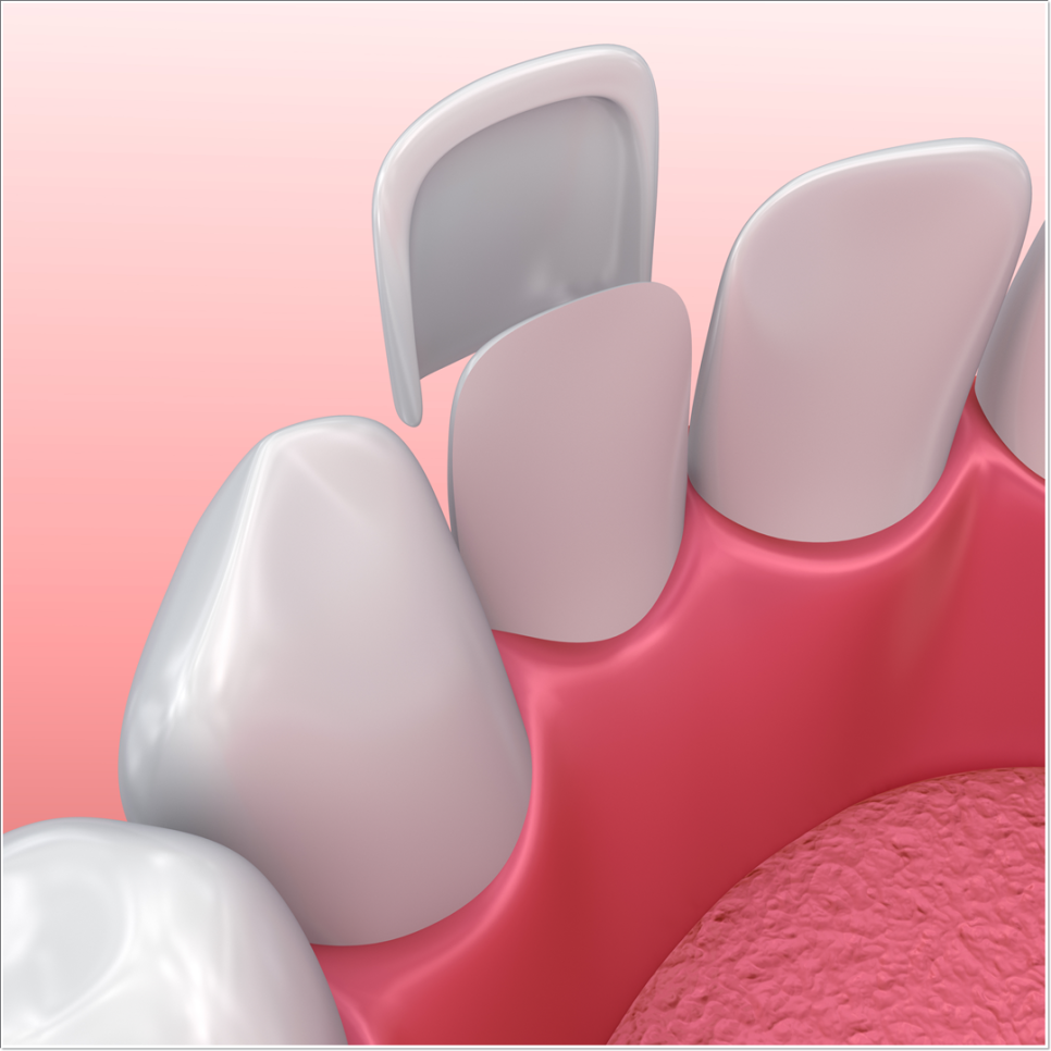 치아 변색 고민 끝, 을지로치과에서 듣는 라미네이트 사례 관련 이미지 19