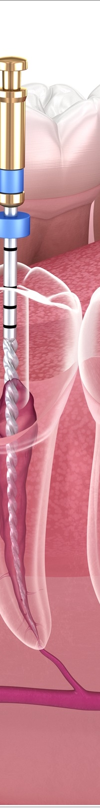 종각역치과 자연치아를 살리기 위한 대책, 신경치료 관련 이미지 13