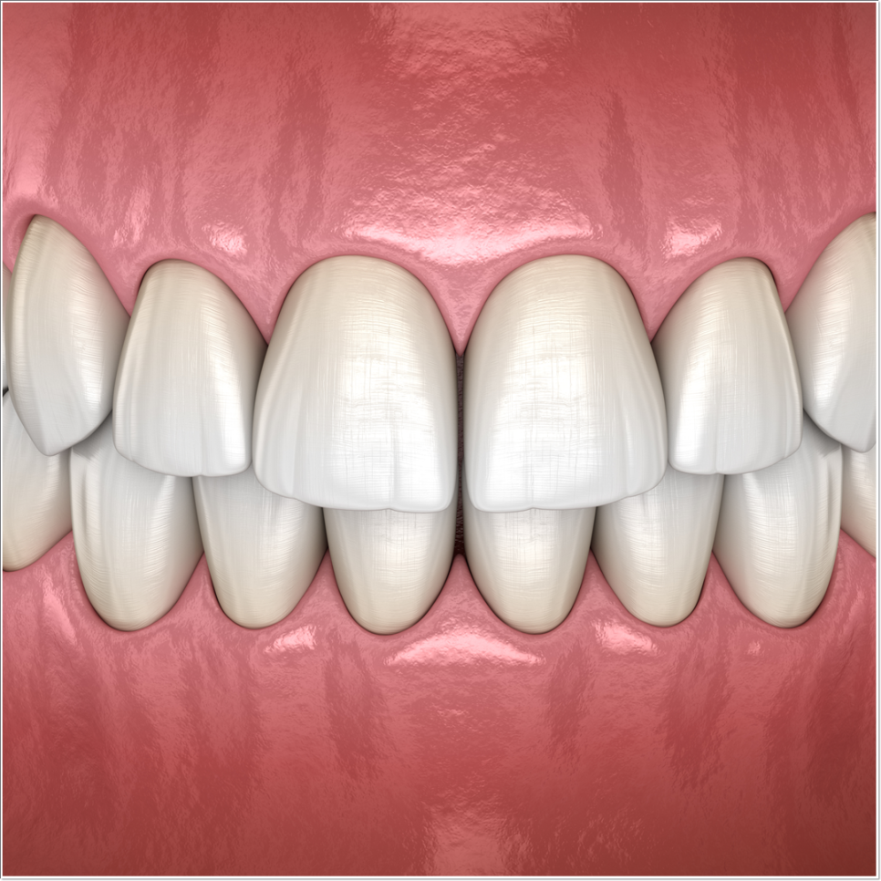 치아 변색 고민 끝, 을지로치과에서 듣는 라미네이트 사례 관련 이미지 10