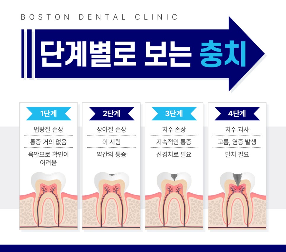 외국인치과 충치, 신경치료 고민하고 계신가요? 관련 이미지 2