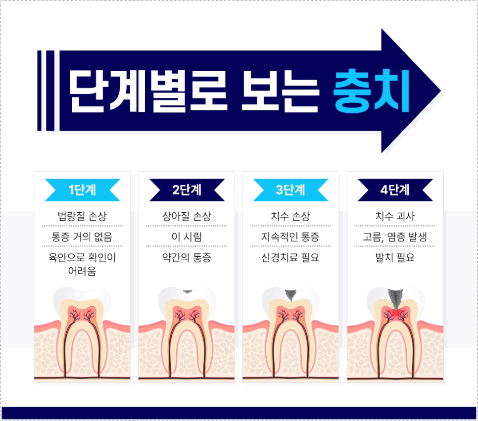 명동치과에서 들은 충치부터 신경치료까지 핵심정리 관련 이미지 3