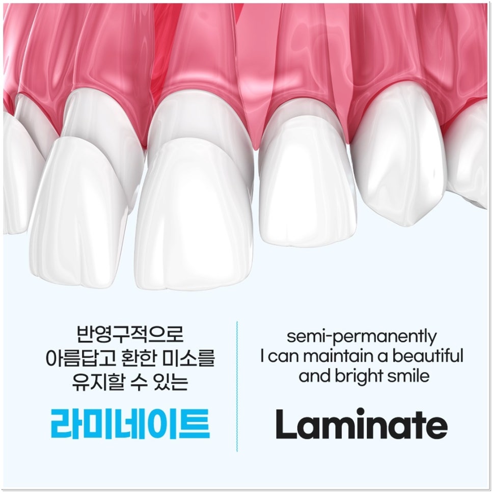 치아 변색 고민 끝, 을지로치과에서 듣는 라미네이트 사례 관련 이미지 3