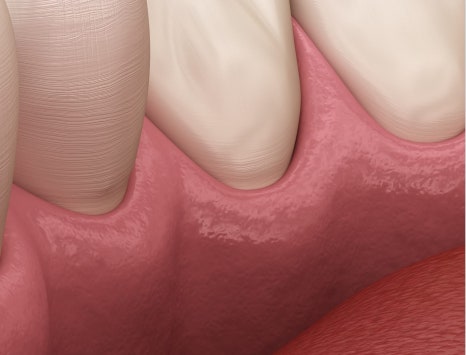 종로치과 충치가 생겼을 때 어떻게 치료 받아야 하나요? 관련 이미지 24