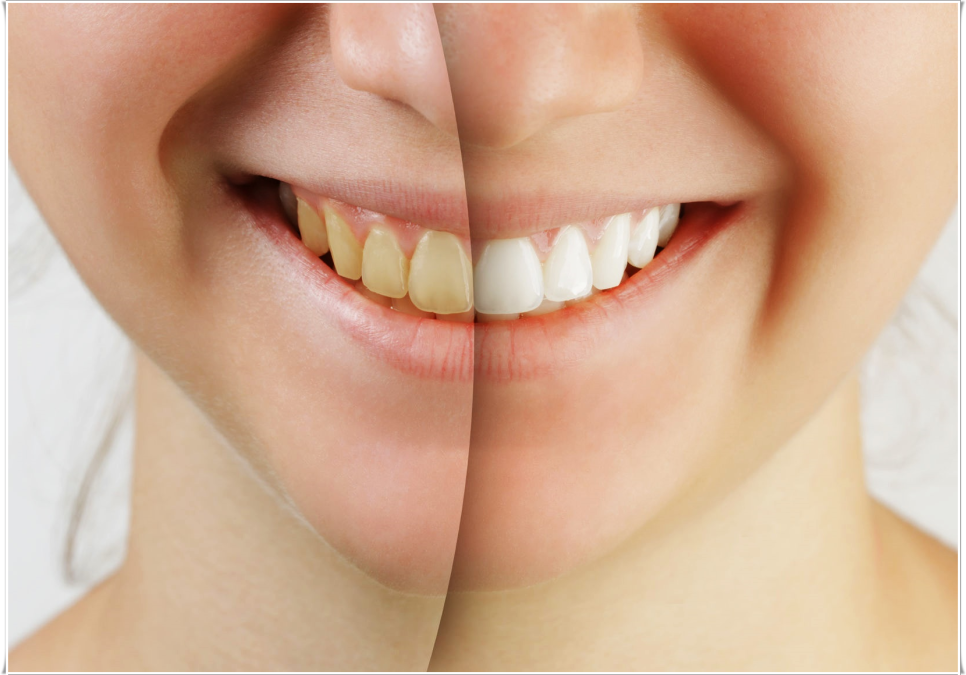 을지로입구역치과에서 알려드리는 치아미백과 라미네이트의 모든 것 관련 이미지 7