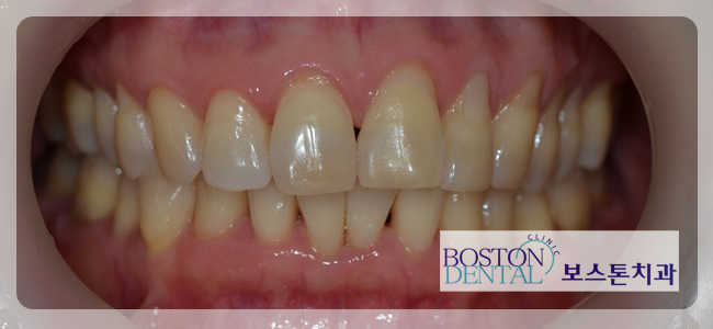 광화문치아미백 확실한 효과~! 관련 이미지 5