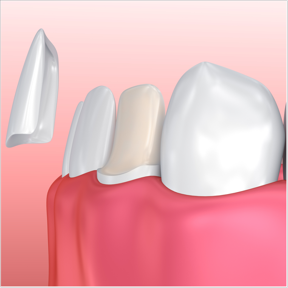 치아 변색 고민 끝, 을지로치과에서 듣는 라미네이트 사례 관련 이미지 21