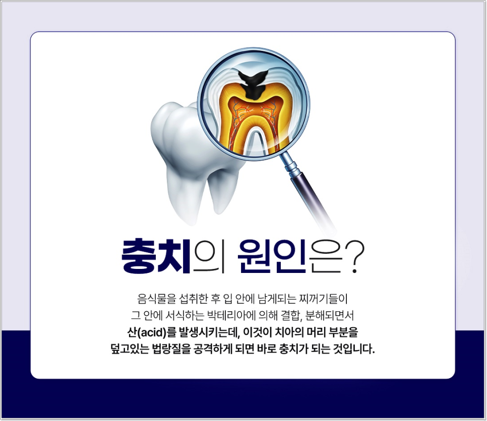 충치, 치료 미루면 더 아프고 더 비싸집니다 &ndash; 종각치과에서 꼭 알아야 할 이야기 관련 이미지 2