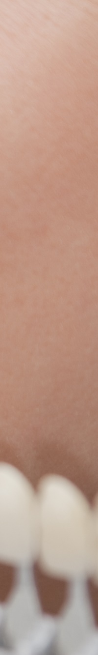 종로치과 자연스러운 라미네이트 색, 얼마나 하얘야 예쁠까? 관련 이미지 15