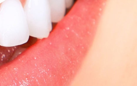 종로치과 치아미백 밝고 환하게 관련 이미지 21