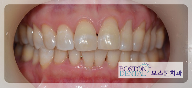 광화문치아미백 확실한 효과~! 관련 이미지 6