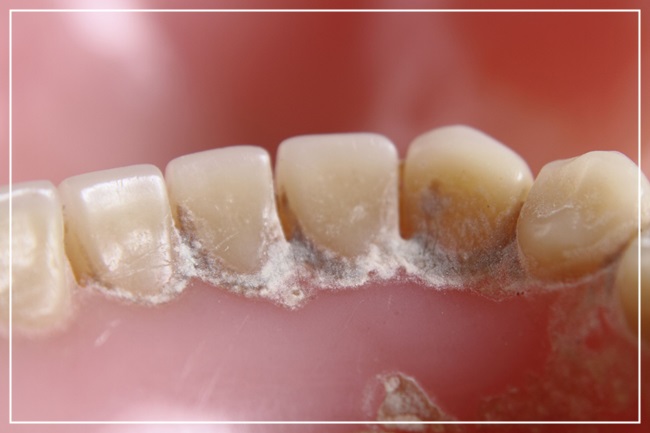 찌릿찌릿, 이가 시린 원인 관련 이미지 4