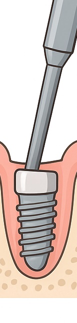 종각치과 임플란트 치료 후 관리 관련 이미지 10