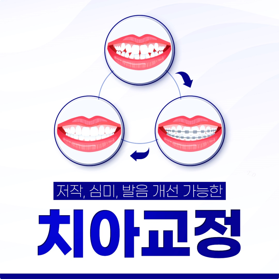 을지로치과에서 알려준 투명교정의 모든 것! 티 안 나게 교정하는 방법 완벽 가이드 관련 이미지 1