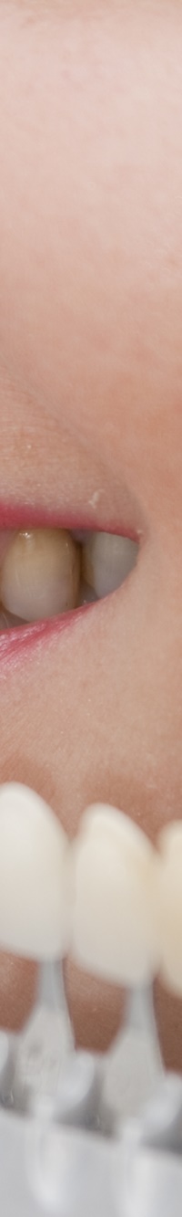 종로치과 자연스러운 라미네이트 색, 얼마나 하얘야 예쁠까? 관련 이미지 13