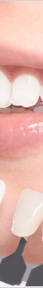 광화문치과 라미네이트 치료 전 고민해야 할 것 관련 이미지 29