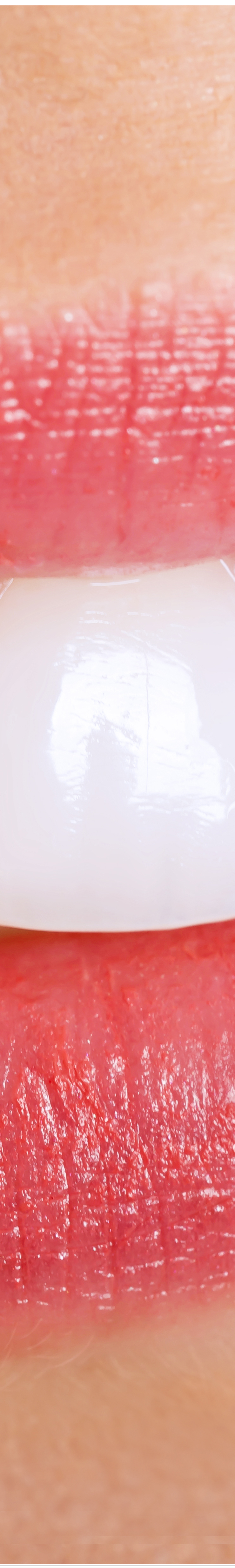 종로3가치과에서 알려드리는 무삭제 라미네이트 완벽 가이드 관련 이미지 15