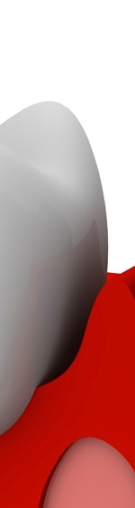 광화문치과 라미네이트 깨짐&middot;들뜸 원인과 예방 방법 완벽 정리 관련 이미지 11