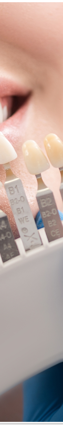 광화문역치과 치아미백과 라미네이트 나에게 필요한 건? 관련 이미지 19