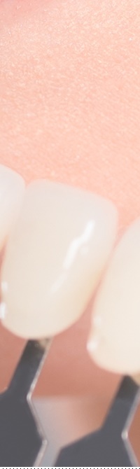 종로치과 라미네이트 주변 치아를 확인하여 자연스럽게 관련 이미지 24