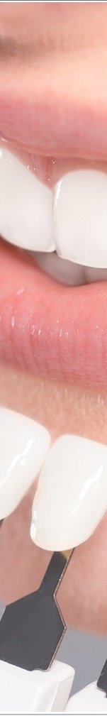 광화문치과 라미네이트 치료 전 고민해야 할 것 관련 이미지 28