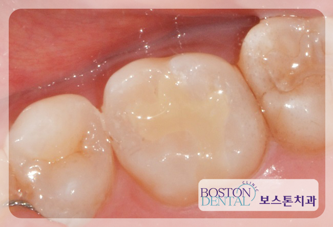 광화문치과추천 충치치료 편하게~ 관련 이미지 6