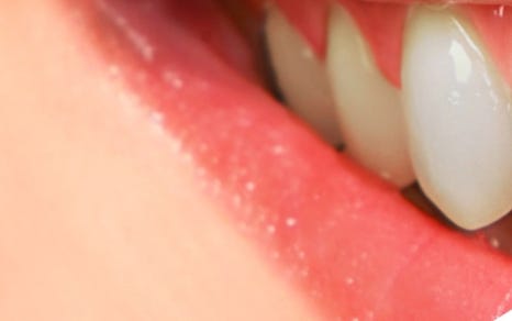 종로치과 치아미백 밝고 환하게 관련 이미지 19