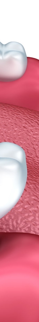 종각역치과 충치를 방치하면 신경치료를 해야 한다. 관련 이미지 16