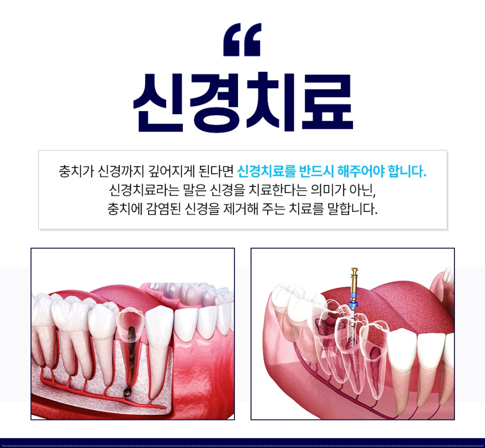 A Guide to Cavity Treatment from Jonggak Station Dental Clinic image 4