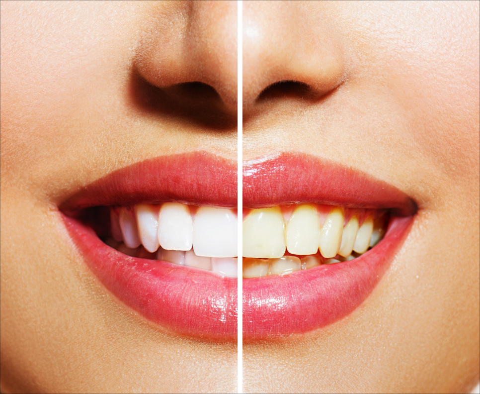 명동치과에서 알아보는 치아미백의 모든 것 관련 이미지 6