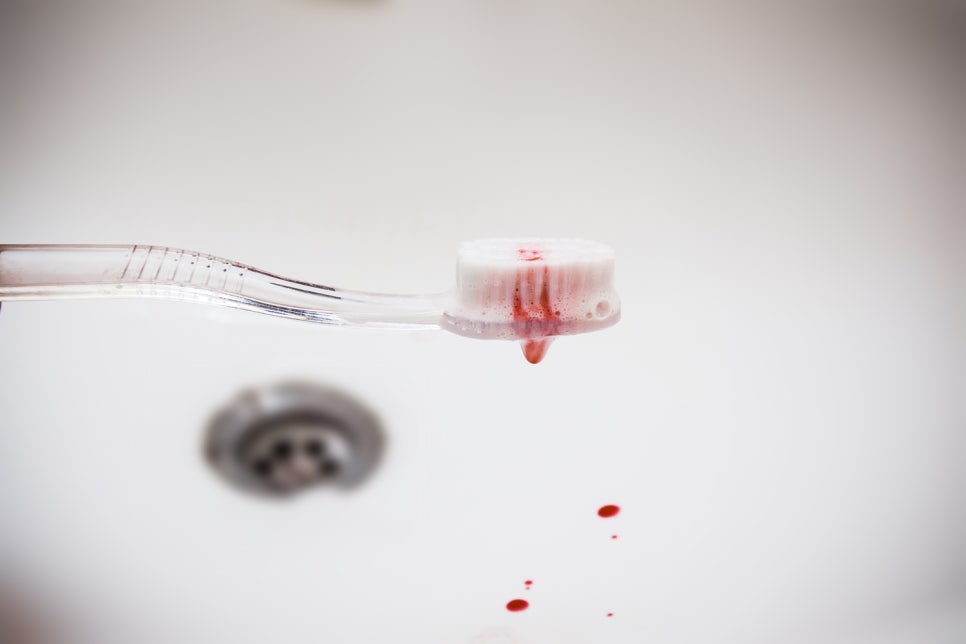 양치할 때 잇몸에 피가 나나요? 관련 이미지 1